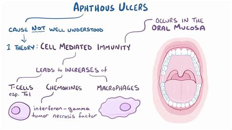 Aphthous Stomatitis What Is It Symptoms And More Osmosis