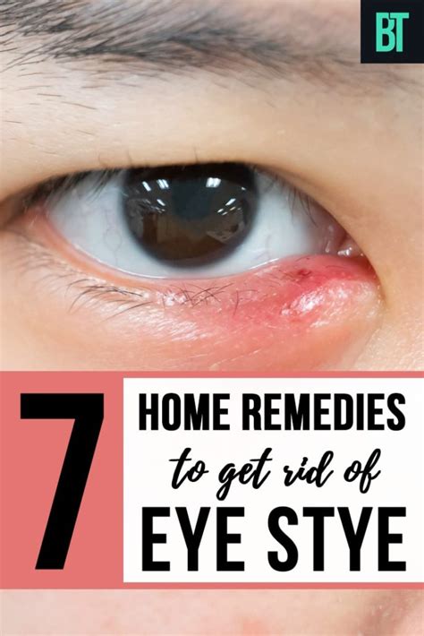 Eye Stye Causes And 7 Best Home Remedies To Treat Eye Stye