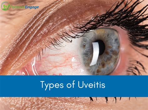 Types Of Uveitis Patientsengage
