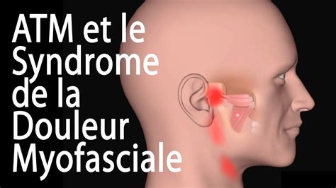 Latm Et Le Syndrome De La Douleur Myofasciale Animation Youtube