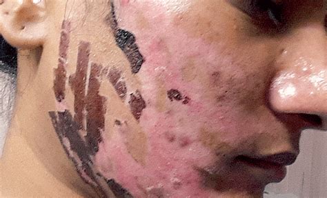 Some want to leave a goatee or some small amount of hair on their upper lip, while others want to completely wipe their face clean. Hyderabad: Physiotherapist carried out laser hair removal ...