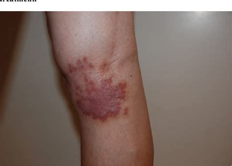 Figure 1 From A Case Of Lupus Vulgaris With Rare Localization Diagnosed