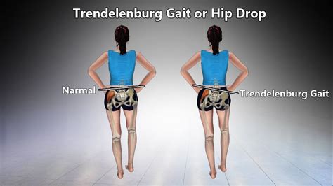 Exercises For Trendelenburg Gait Or Hip Drop Youtube