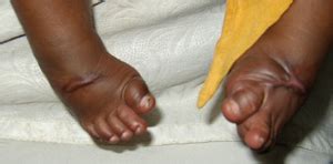 Patients with club feet often appear to walk on their ankles. Club Foot | Spot Diagnosis | Pediatric Oncall