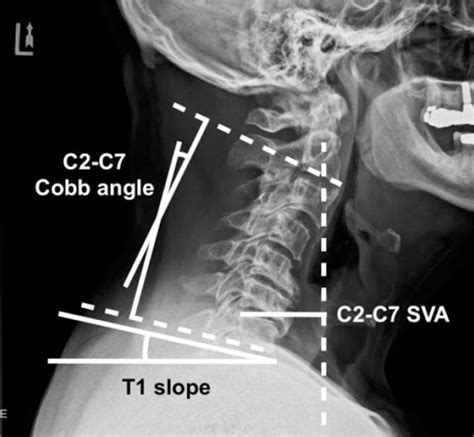 Cervical Sagittal Alignment In Patients With Cervical Spondy Spine