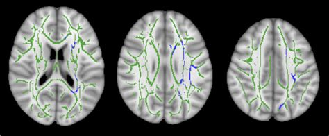 Cognitive Deficit And White Matter Changes In Persons With Celiac