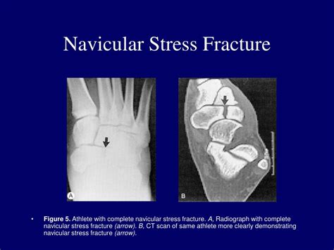Ppt Foot Stress Fractures Powerpoint Presentation Free Download Id
