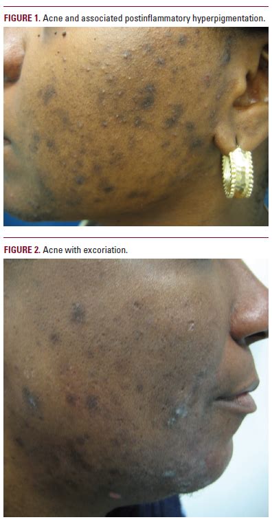 Acne Vulgaris In Skin Of Color Understanding Nuances And Optimizing