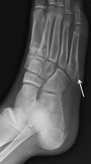 Kickboxing Power Hour Case Report Of Fifth Metatarsal Apophysitis Iselin Disease And Its