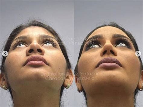 cosmetic surgery photos of miss venezuela go viral after she becomes miss universe 2018 2nd