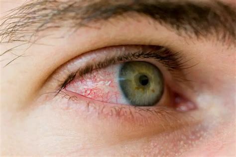 How To Get Rid Of Bloodshot Eyes