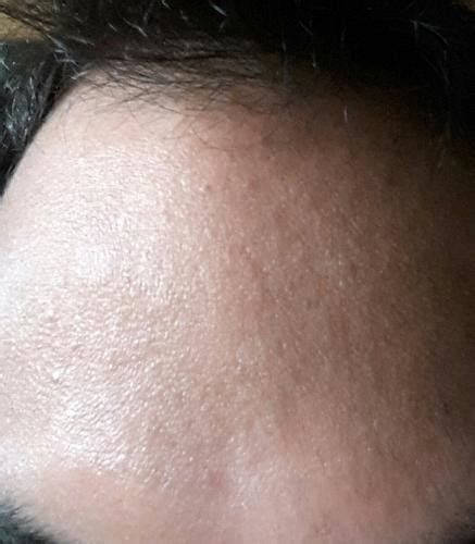 Get Rid Of Tiny Bumps On Face Get Rid Of Bumps
