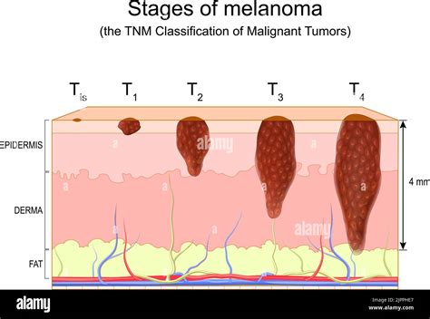 Stages Of Melanoma The Tnm Classification Of Malignant Tumors