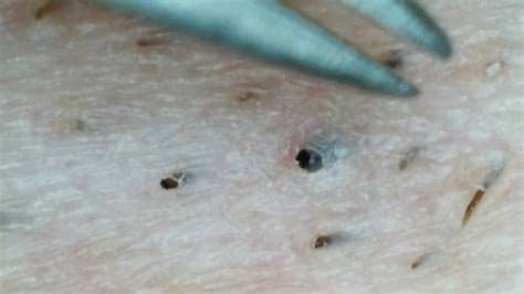 In summary, this article covers what causes ingrown hair in armpits and suggests the best remedies, prevention, and removal ways. Armpit abscess popping