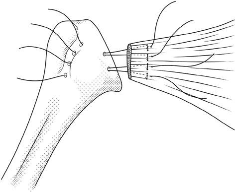 Sketch Of Subscapularis Peel Repair Featuring Medial And Lateral Drill