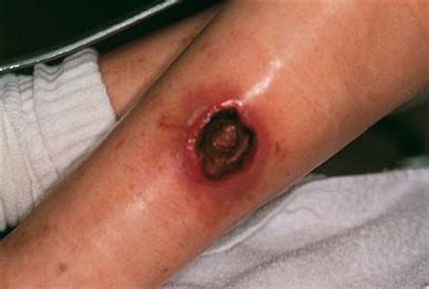 Brown Recluse Spider Bite Pictures Symptoms Stages Treatment
