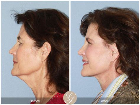 Neck Lift Before And After Photos From Dr Kevin Sadati
