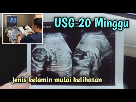 Hasil USG Janin 20 Minggu YouTube