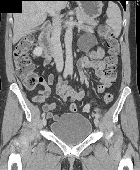 Left Hydronephrosis Due To Transitional Cell Cancer Tcc In The Mid