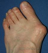 Images of Recovery Time For Bunion Removal