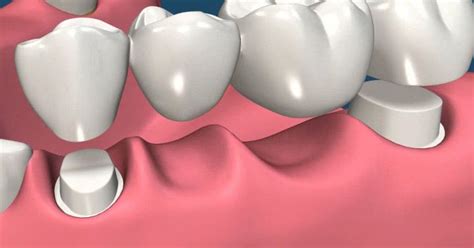 Que es y como se hace un puente dental Odontología al Dia