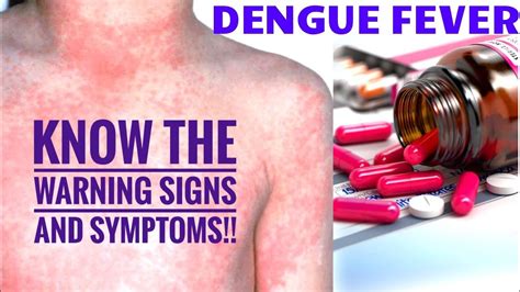 Dengue Fever Signs Symptoms Treatment Prevention Things You Must