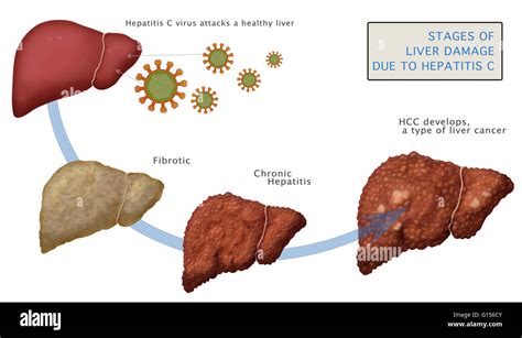 Diagrama que muestra las etapas de daño hepático debido a la cirrosis causada por hepatitis