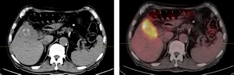 Cureus 18f Fdg Petct Imaging Of Gallbladder Adenocarcinoma A