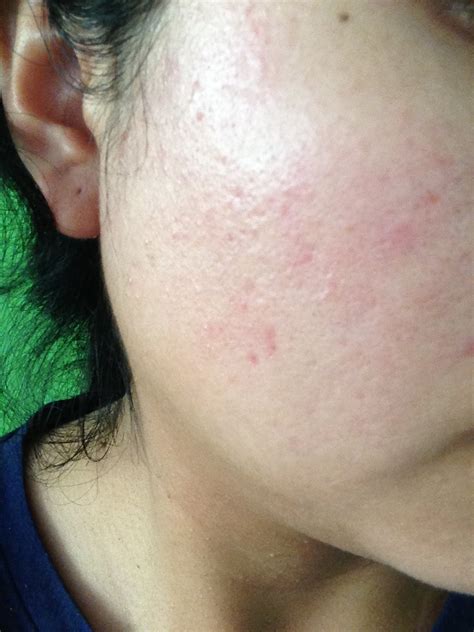Could You Help Me Know If I Have Acne Rosacea Rosacea And Facial