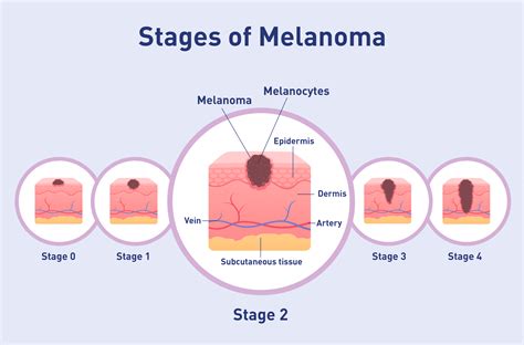 Stage Melanoma Focus