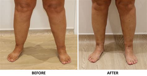 Ankle Contouring Cankles At The Karri Clinic
