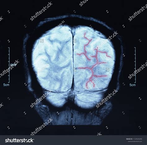 Mri Blood Vessels Brain Cerebrovascular Disease Stock Photo 1124529290