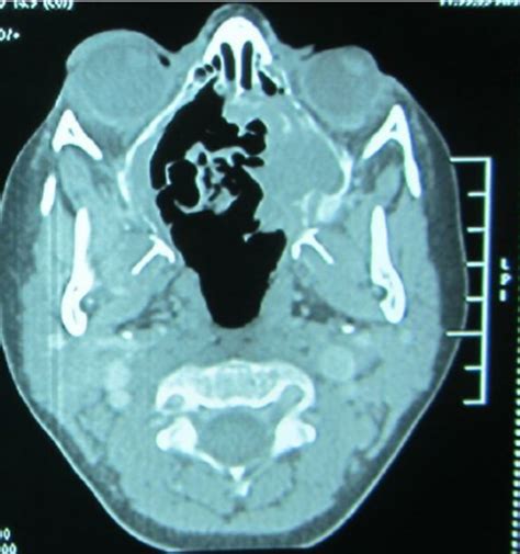 Axial Ct Scan Of The Paranasal Sinus With Contrast Revealed An