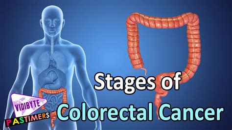 Stages Of Colorectal Cancer Health Tips Youtube