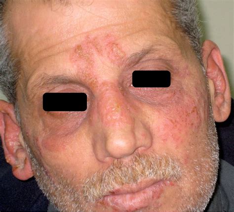 Both types are incurable and can lead to periodic outbreaks. Disseminated primary HSV-2 infection of the face