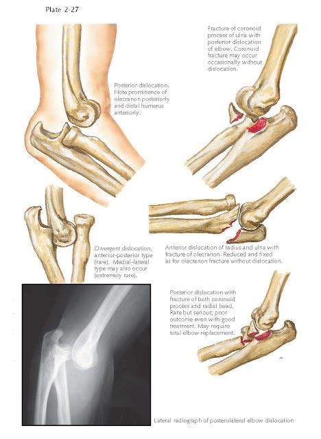 Dislocation Of Elbow Joint Dislocations Of The Elbow Joint Are The Most