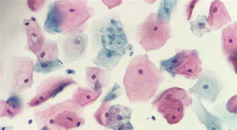 Pathology Outlines Trichomonas Vaginalis