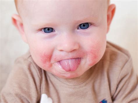 What Does Teething Rash Look Like Pictures And Treatments
