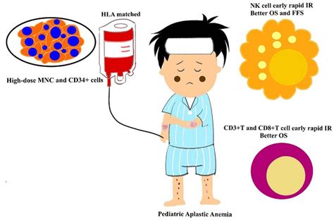 Immune Reconstitution In Pediatric Aplastic Anemia After Allogeneic