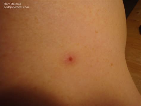In many cases, the patient never feels the bite—just the cramps. American House Spider Bite
