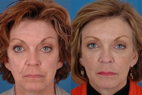 Patient 1 Sculptra Before And After Dallas Advanced Facial Plastic Surgery Center