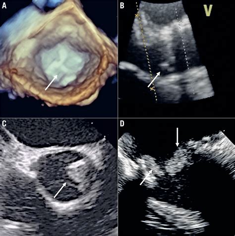 Transcatheter Aortic Valve Implantation In Degenerated Surgical Aortic