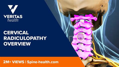Cervical Radiculopathy Overview Youtube