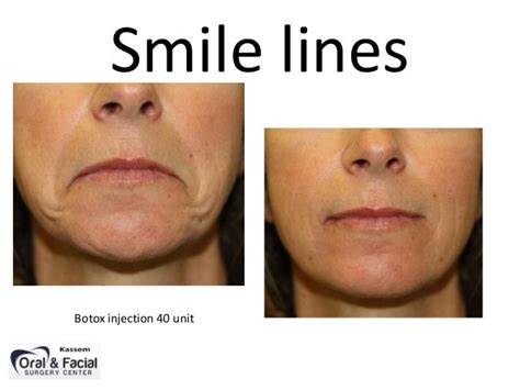 Smile Line Using Botox