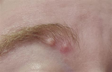 Anyone Know What These Bumps On My Eyebrow Are Rdermatologyquestions