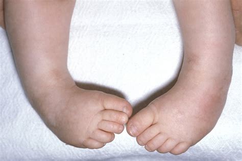 In clubfoot, the foot of the baby is twisted out of shape such that it is curved inwards or. Club Foot - Congenital Clubfoot Causes, Types, Symptoms ...
