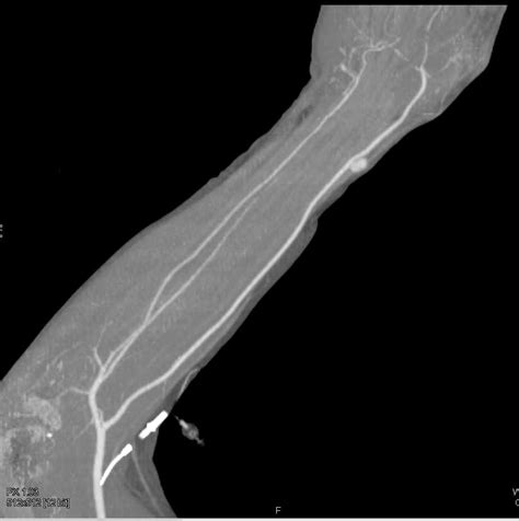 Pseudoaneurysm Distal Radial Artery Vascular Case Studies Ctisus Ct