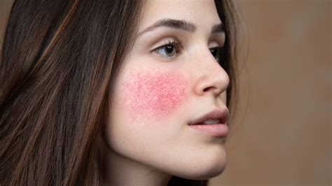 Rosacea Explained Causes Symptoms And Treatments