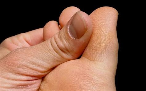 Frequently Asked Questions About Foot Calluses And Corns