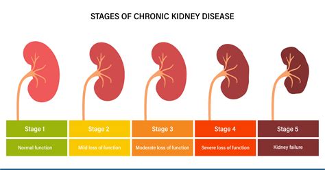 What Are The 5 Stages Of Chronic Kidney Disease